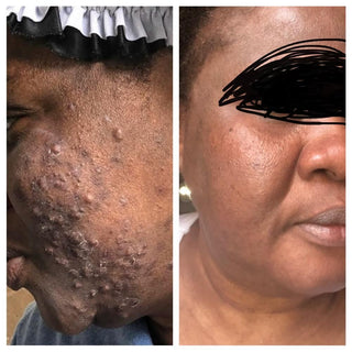 Extra Strength Lightening Acne Bundle