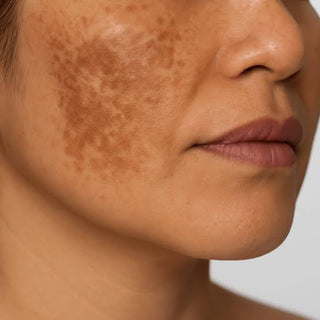 Hyperpigmentation & Discoloration/Dark Marks